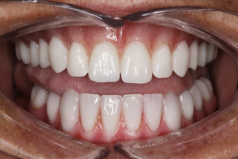 Denture New About Smiles Dental Centres - Denture