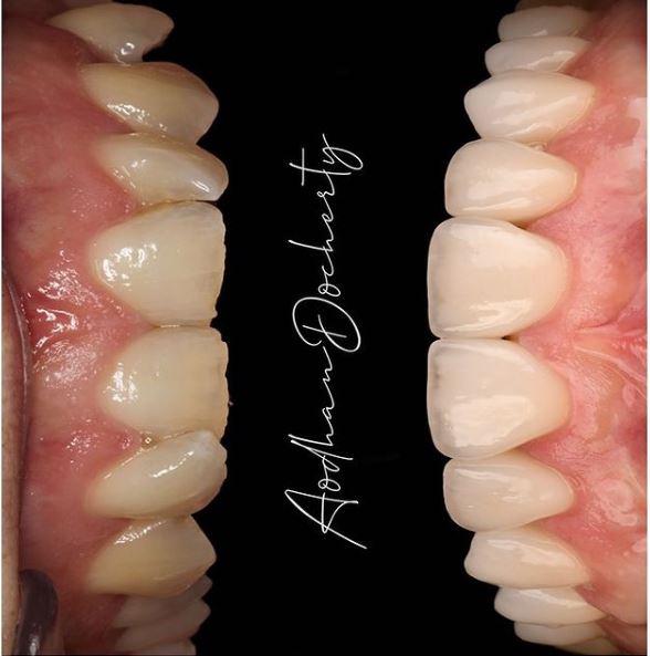 About Smiles Dental Centres - Invisalign
