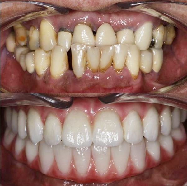 Before and after dental implant