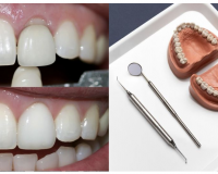 Do missing teeth have to be replaced?